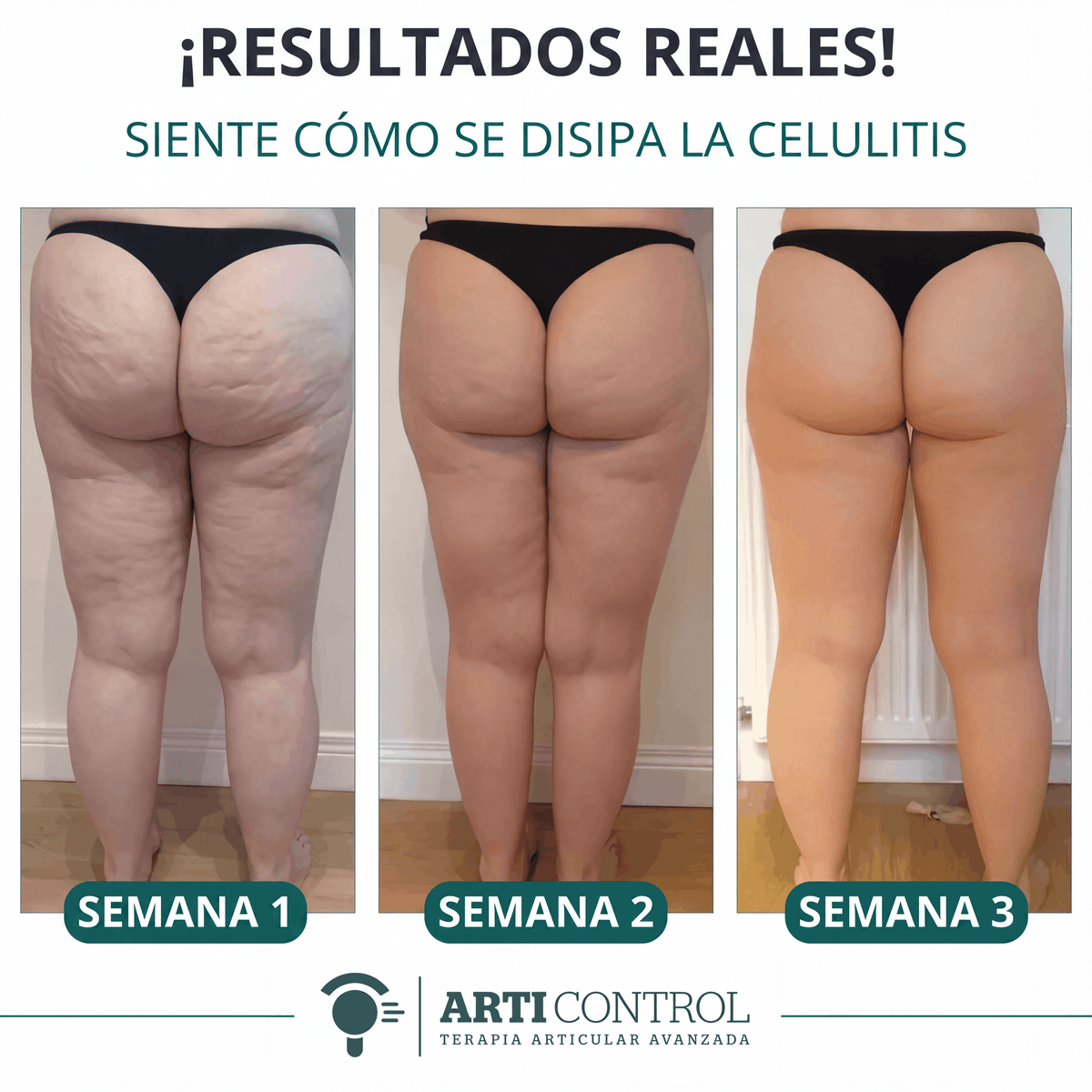 Celu Lift | Arti Control | Disuelve tu Celulitis Antes de Verano